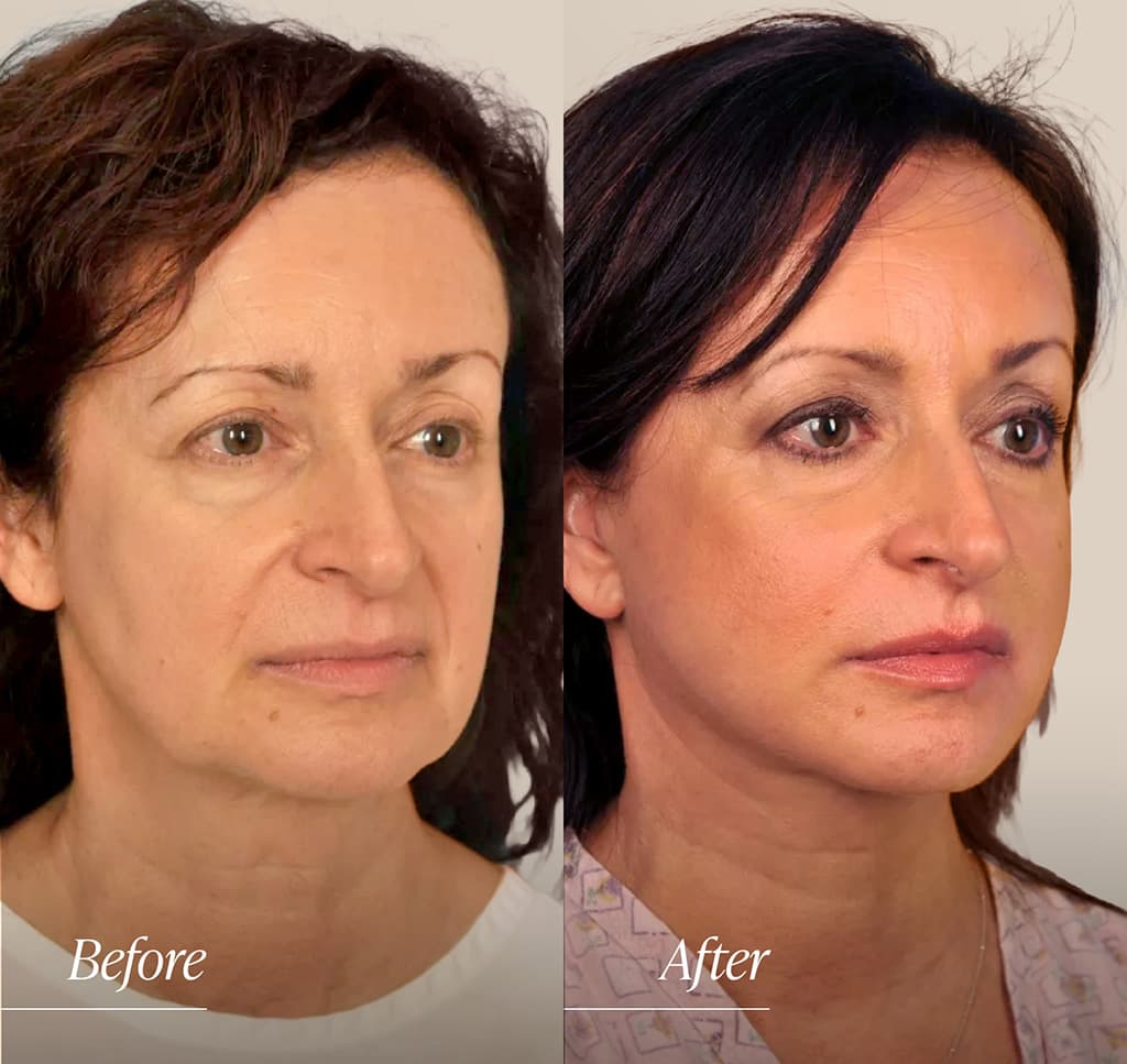 Facelift Before and After