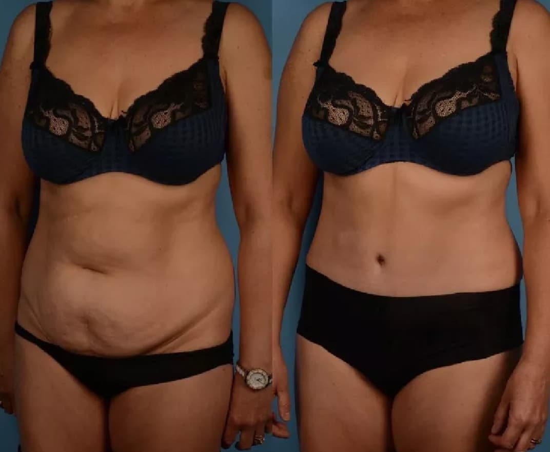 Before and After Photos