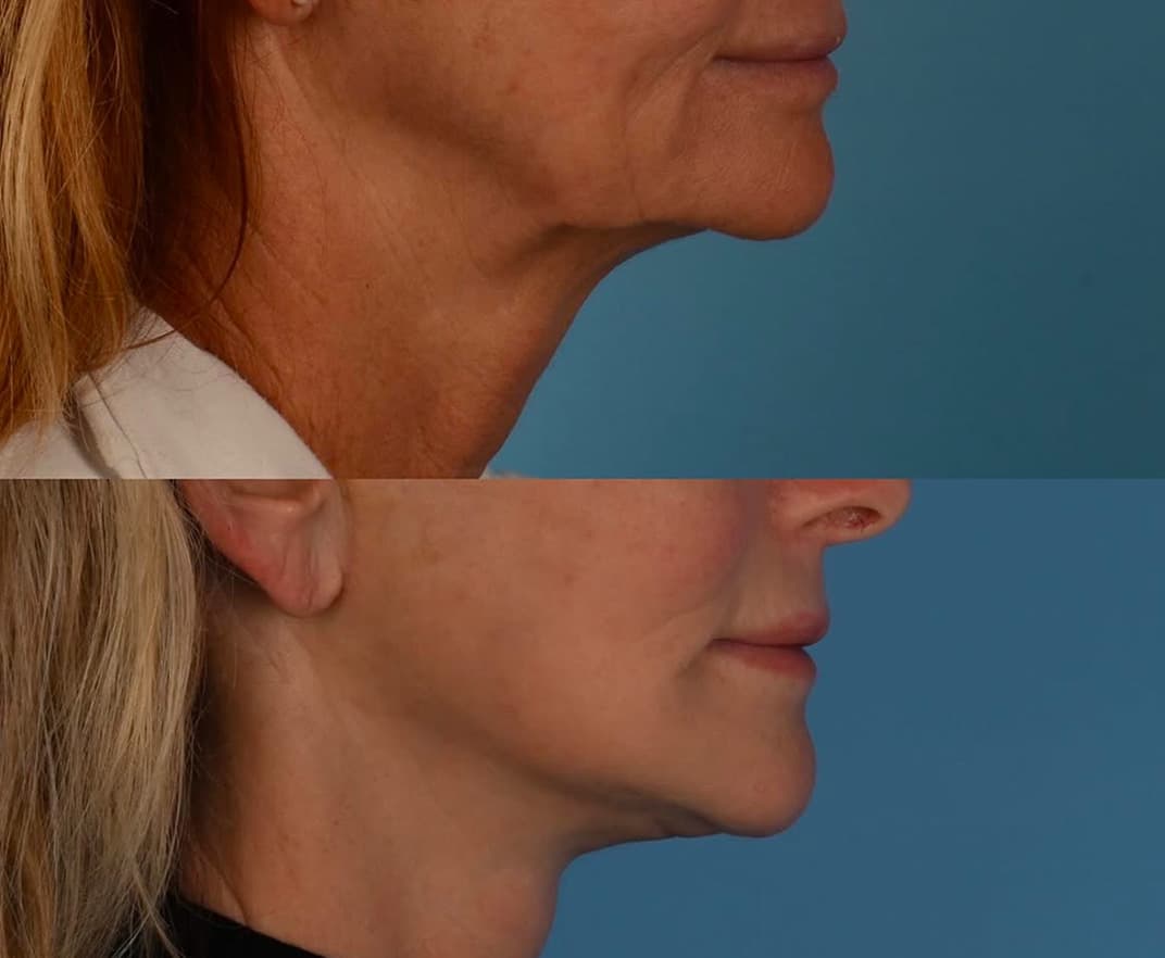 Before and After Photos