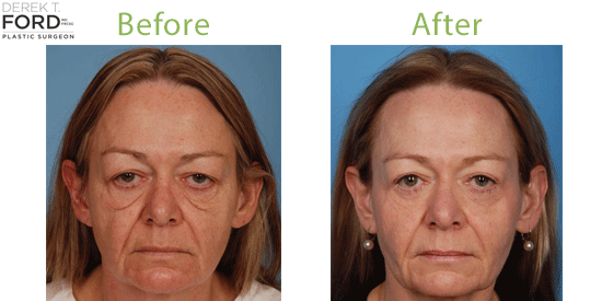 See before-and-after photos of real eyelid surgery patients at Ford Plastic Surgery in Toronto.