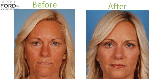 See before-and-after pictures from blepharoplasty patients in Toronto.