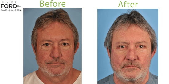 See images of blepharoplasty patients in Toronto.