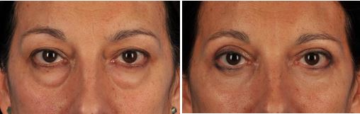 Eyelid surgery before-and-after photos