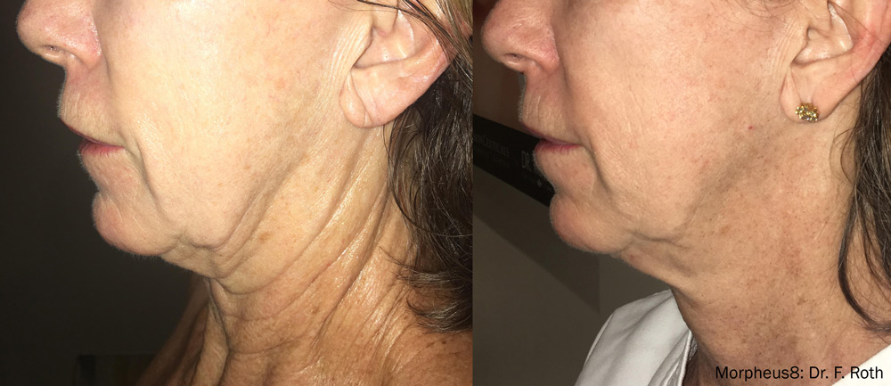 Before and after Morpheus8 RF Microneedling