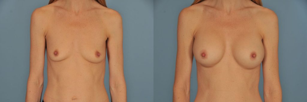 Close-up of breasts before and after breast augmentation with implants.
