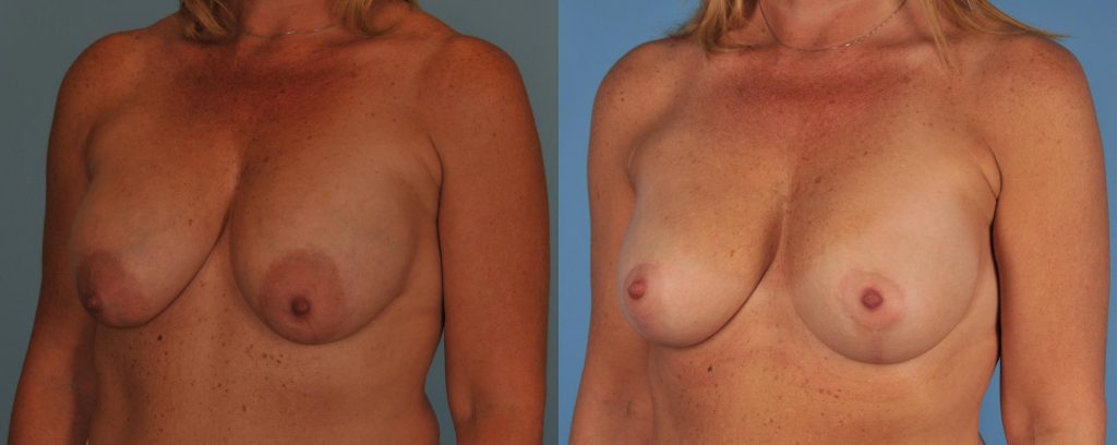 Breasts before and after breast lift surgery.