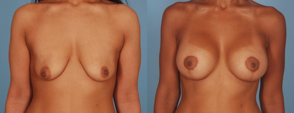 Close-up view of smaller, lax breasts before a breast lift with implants and the fuller, perkier breasts after the procedure.