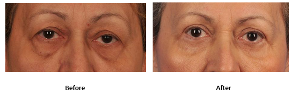 Blepharoplasty before and after with Toronto surgeon Dr. Derek Ford.