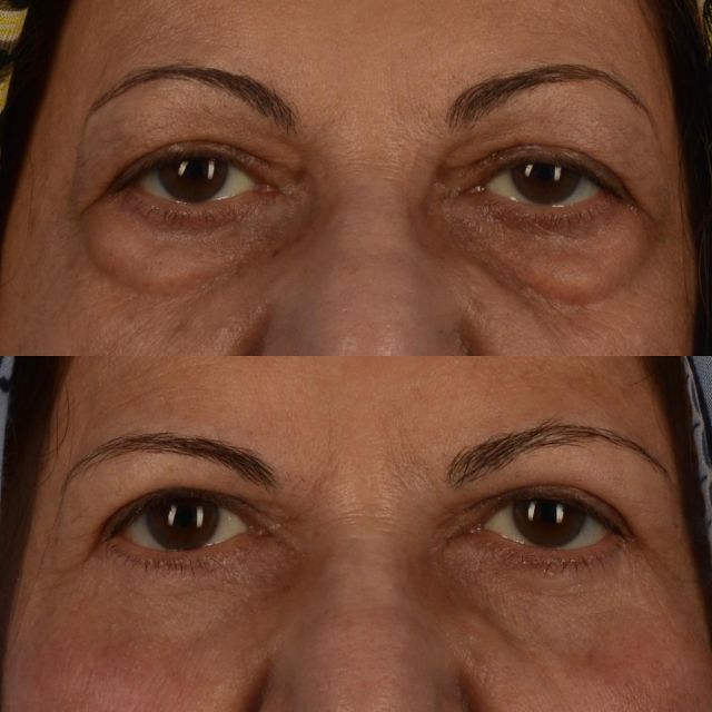 The changes that we can achieve with eyelid surgery can have a tremendous impact on the lives of our patients.  We are thankful to this 72 year old patient of mine who has agreed to share her photographs.  She underwent upper and lower blepharoplasty surgery with upper eyelid ptosis repair and fat grafting to her upper cheeks.  The photograph below was taken 9 months following surgery.  Contemporary eyelid surgery is characterized by fat preservation rather than removal.  for more information please contact our office by calling 416-925-7337.  #blepharoplasty #eyelidlift #fatgrafting #plasticsurgery #lowerblepharoplasty #upperblepharoplasty #toronto #blooryorkville #yorkvillevillage #oculoplastics