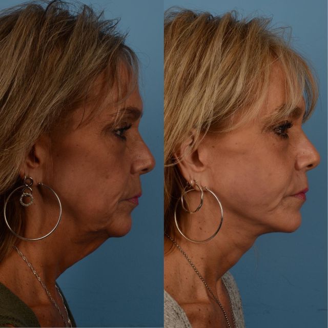 One of the most common concerns patients express with facial aging is the development of jowels and a loss of neck definition.  It is important to tighten the platysma or deep plane, both in the face and in the neck to be able to achieve optimal facial harmony.  Addressing the neck in isolation often does not result natural outcomes.  This patient of mine, who is in her mid 50s, underwent face/neck lift surgery with facial fat grafting.  The photograph on the right was taken 3 months following surgery.  Please contact our office at 416-925-7337.  #facelift #necklift #plasticsurgery #faceliftexpert #fatgrafting #blooryorkville #yorkvilletoronto #toronto