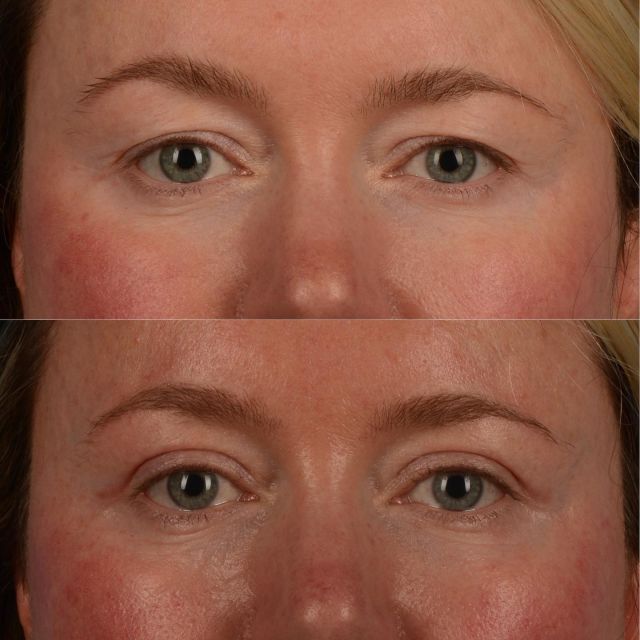 During the consultation process, we are often asked how long will the recovery take?  This beautiful patient of mine, who is in her early 40s, is photographed in the picture below just six weeks following upper blepharoplasty surgery.  Although the final result post surgery is typically seen in 6 to 12 months, at 6 weeks we often can anticipate our final outcome.  A consultation can be scheduled by calling 416-925-7337.  #plasticsurgery  #blepharoplasty #eyelidlift #upperblepharoplasty #oculoplastics #blepharoplastytoronto #blepharoplastyexpert #toronto #torontolife #blooryorkville