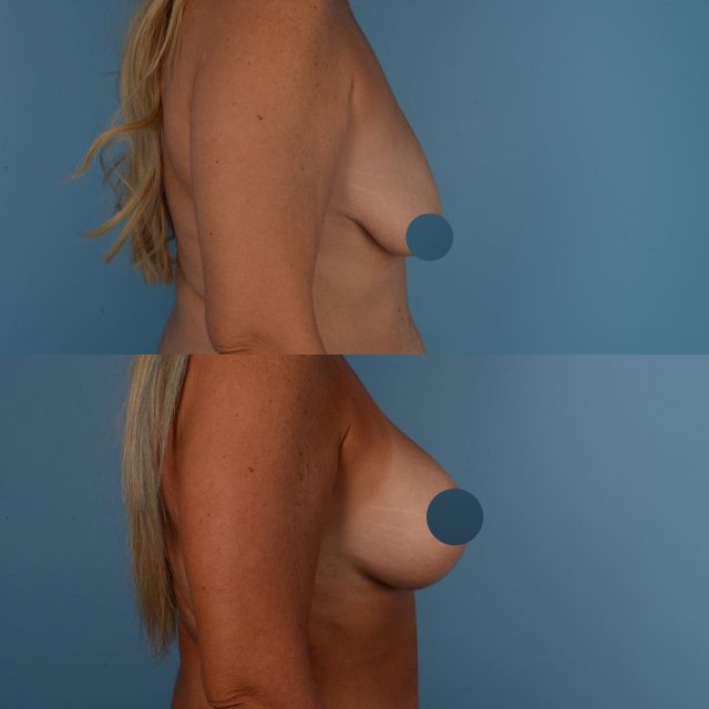 Patients seeking breast augmentation surgery commonly request both a change in breast size and shape.  Breast size can be increased with the use of breast implants and/or fat grafting.  It is also necessary to evaluate if the nipple position is low.  In these situations, a breast lift (mastopexy) procedure is often recommended to achieve the best outcome.  The photograph below was taken three months following a breast lift (mastopexy) and breast augmentation procedure.  This wonderful patient of mine is in her late 40s, and is a mother of two children.  A combined procedure was used to achieve her goals.  A consultation can be scheduled by calling 416-925-7337. #plasticsurgery #breastaugmentation #mastopexy #breastlift #toronto #blooryorkville