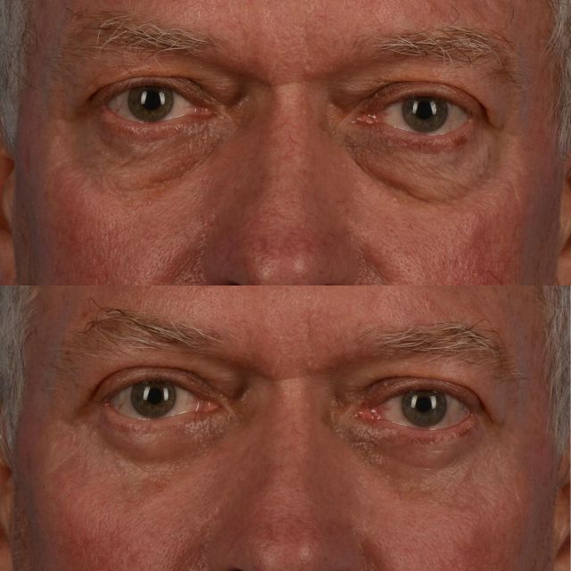 As our lower eyelids age, we often see a laxity in the lower eyelid orbicularis oculi muscle.  It is important to tighten this muscle in order to most effectively blend the lower eyelid cheek junction.  This also minimizes the risk of changing eyelid shape, especially when the eye is prominent.  Pictured is an amazing patient of mine, who is in his mid 60s, underwent lower blepharoplasty surgery with fat grafting.  The photograph below was taken four months following surgery.  Our office can be contacted by calling 416-925-7337 to attain further information.  #plasticsurgery #oculoplastics #blepharoplasty #blepharoplastyexpert #eyelidlift #toronto #torontolife #blooryorkville