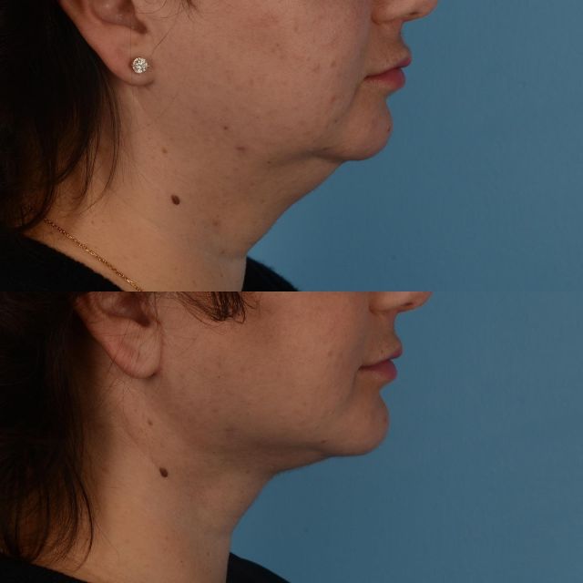 I am often asked when is the best time for face/neck lift surgery.  The best results are often attained in patients with good skin elasticity.  It is most common to perform this procedure for patients in their mid 40s to mid 60s.  However, there are times when this procedure is indicated in younger patients as an effective way to shape the jawline and neck.  This incredible patient of mine, who is in her late 30s, disliked the shape of her neck and jaw contour.  She is photographed 6 weeks following face/neck lift surgery which included deep neck contouring, platysmaplasty and the use of a chin implant to further define her profile.  We are thrilled with her outcome as is she.  Our office can be contacted by calling 416-925-7337 to attain further information, and to schedule a consultation time.  #plasticsurgery #deepnecklift #platysmaplasty #facelift #faceliftexpert #neckliftexpert #facelifttoronto #toronto #torontolife #blooryorkville
