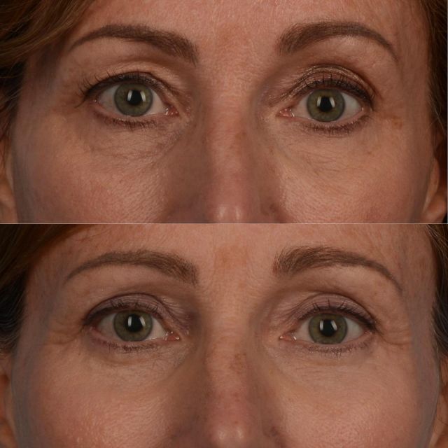 Asymmetry in the face occasionally becomes more apparent as we age.  Blepharoplasty surgery can often improve eyelid asymmetries by cleaning up tissue laxity.  This amazing patient of mine, who is in her mild 50s, underwent upper and lower blepharoplasty surgery with fat grafting to her upper cheeks.  The photograph below was taken 5 months following surgery.  The symmetry of her upper face is improved, bringing a fresher harmony to her appearance.  Our office can be contacted by calling 416-925-7337 to schedule a consultation time.  #blepharoplasty #plasticsurgery #eyelidlift #fatgrafting #oculoplastics #oculoplasticsurgery #upperblepharoplasty #lowerblepharoplasty #toronto #torontolife #blooryorkville