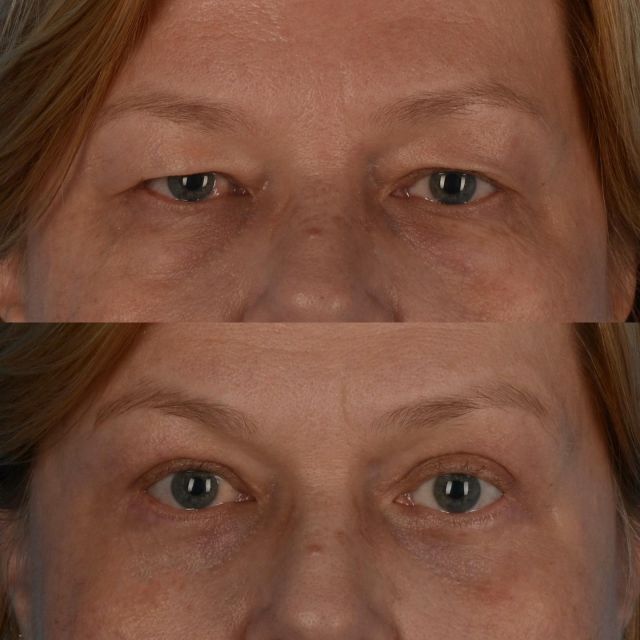 Of all elective cosmetic procedures, eyelid surgery can have the most dramatic outcomes.  The surgical procedure establishes a more alert and rested appearance to the upper face without changing the identity of our patients.  We thank this generous patient of mine, who is in her late 50s, and has agreed to share her photographs.  The photograph below was taken 4 months following upper and lower blepharoplasty surgery with microfatgrafting to the upper cheeks.  We are thrilled with her progress.  Our office can be contacted by calling 416-925-7337 to schedule a consultation time.  #blepharoplasty #oculoplastics #microfatgrafting #eyelidlift #plasticsurgery #upperblepharoplasty #lowerblepharoplasty #toronto #torontolife #blooryorkville