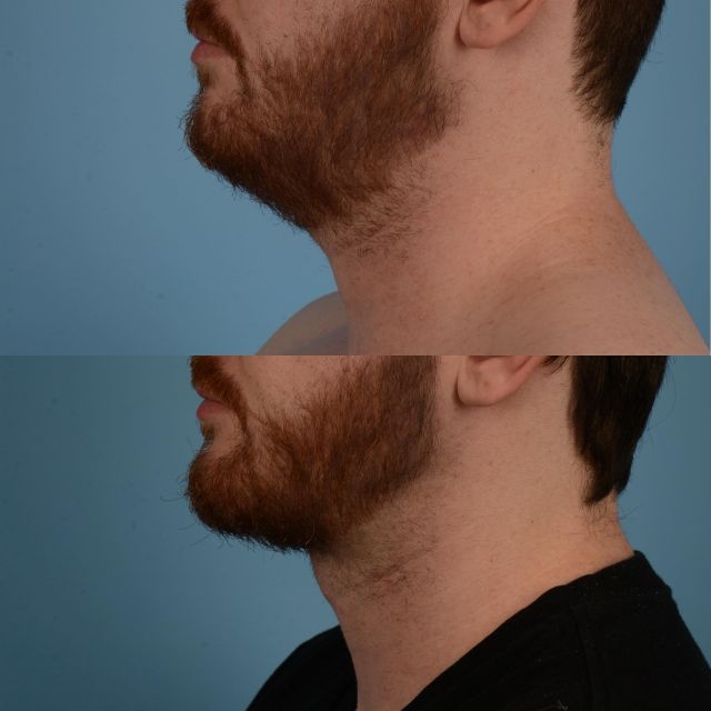 Deep neck lift surgery is a procedure that contours the shape of the neck by addressing the fat under the skin and deep neck fat under the platysma muscle in the neck.  Furthermore, the diagastric muscles and platysma muscles in the neck are tightened to sharpen the neck shape.  Occasionally, the submandibular glands are reduced also.  This procedure is performed using only one incision under the chin in patients that have good skin elasticity.  The procedure is commonly performed with face lift surgery also.  This patient of mine, who is in his 30s, is pictured below approximately 4 months following deep neck lift surgery.  There are no incisions present around his ears.  It is amazing how the skin will reposition to the new shape of the neck based on a change in neck volume and internal contour.  #deepneck #deepnecklift #facelift #facenecklift #deepplanefacelift #toronto #torontolife #blooryorkville #plasticsurgery