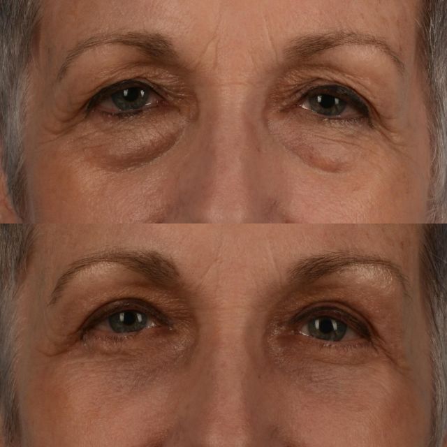 How do I attain a smooth transition between the lower eyelid and cheek?  In our practice, we have found our outcomes and durability of results, to be better in the long term, by treating the lower eyelid as we would the face during facelift surgery.  Contemporary approaches to face lift surgery employ tightening of the muscle layer of the face, and contouring with fat redistribution and fat grafting.  Tightening of the deep plane improves the longevity of the surgical outcome in face lift surgery.  Similarly, techniques that address the lower eyelid orbicularis oculi muscle tend to provide a longer lasting surgical result in patients who have lower eyelid laxity.  This patient of mine, who is in her mid 60s, is photographed below 4 months following upper and lower blepharoplasty surgery with microfatgrafting to the upper cheeks and Erbium fractionated laser to the lower eyelid skin to improve its quality.  The lower eyelid blepharoplasty was performed by tightening the lower eyelid orbicularis oculi muscle; similar to what is done during deep plane facelift surgery.  The puffy lower eyelid fat was preserved and repositioned into the depression in the upper cheek.  As a surgeon, it is always a delight to learn how this procedure enhances the quality of life for our patients.  #blepharoplasty #eyelidlift #puffyeyes #microfatgrafting #deepplanefacelift #sciton #plasticsurgery #toronto #torontolife #blooryorkville