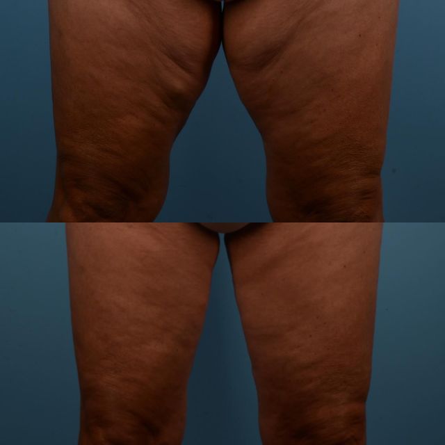 As we age or experience a significant weight loss (which can often be associated with the use of Ozempic), the inner thigh skin often becomes loose.  Liposuction on its own can result in further laxity of this area. If the laxity in the area is minimal, skin contraction with the use of Renuvion or J Plasma can be a helpful adjunct to liposuction.  However, if there is abundant skin laxity anticipated following liposuction, then skin excision is warranted by treatment the area with a medial thigh lift procedure.  This lovely patient of mine, who is in her late 60s, was troubled by the fullness in her inner thighs and how the tissue rubbed together.  This caused discomfort and insecurity for her.  The photograph below was taken one year following bilateral medial thigh liposuction and an excisional medial thigh lift procedure.  The subsequent photographs picture a mature scar which has healed perfectly.  The medial thigh lift scar is located on the inner thigh and extends superiorly into the groin.  The procedure has elevated the level of self confidence and comfort that our patient experiences.  We are thrilled for her, and how it has improved her overall lifestyle.  #plasticsurgery #medialthighlift #thighlift #medialthighliposuction #renuvion #liposuction #ozempic #ozempicweightloss #toronto #torontolife #blooryorkville #jplasma