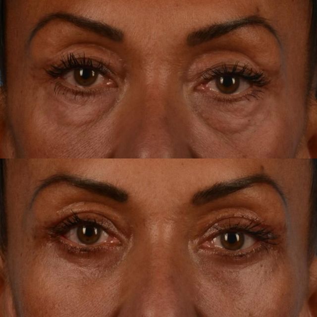 How quickly can I get back to normal after blepharoplasty surgery Dr. Ford?  This very active patient of mine is photographed below approximately 4 weeks after upper and lower blepharoplasty surgery with micro fat grafting to the upper cheeks.  She is in her mid 50s. The lower eyelid procedure was performed using an incision under the eyelash line and a deep plane tightening of the lower eyelid orbicularis oculi muscle.  Most patients are able to be presentable in public two weeks after surgery with makeup.  All bruising is often resolved after 3 weeks post surgery.  The changes associated with surgery will continue to resolve over a period of 6 months for most patients. #plasticsurgery #blepharoplasty #eyelidlift #oculoplastics #microfatgrafting #toronto #torontolife #blooryorkville
