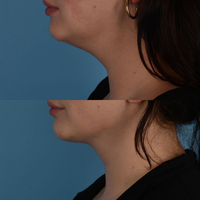 What is the best way to improve the contour of my neck?  If there is ample fat between the platysma muscle in the neck and the skin, liposuction alone can be helpful in achieving a desired slimmer contour.  This technique is best suited for patients who have good tissue elasticity to allow for skin redistribution and retraction in the neck.  If however there is a laxity of the underlying platysma muscle and an excess of fat under the platysma muscle then a deep neck lift procedure is more appropriate.  This beautiful patient of mine is in her late 20s.  She underwent neck liposuction alone and is photographed approximately 5 months following surgery.  Occasionally this procedure can be combined with the use of J-plasma or Renuvion to further enhance skin retraction.  #necklift #facelift #deepplanefacelift #plasticsurgery #neckliposuction #renuvion #jplasma #neckcontouring #toronto #torontolife #blooryorkville