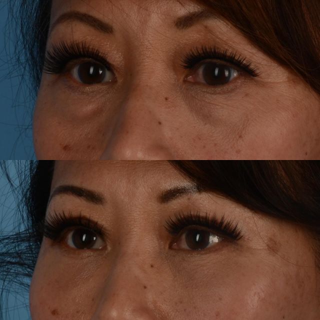 I am excited to review my approach to periorbital rejuvenation.  This sincere and beautiful patient of mine, who is in her early 60s, underwent upper and lower blepharoplasty surgery with micro fat grafting to the upper cheeks. The  bottom photograph was taken approximately 6 weeks following her procedures.  The upper eyelid surgery is performed using an “open sky technique”. This allows the surgeon to contour the fat under the upper eyelid muscle.  By doing this, we can better control upper eyelid symmetry and ensure that the upper eyelid remains full and youthful.  Excess skin is removed from an incision made in the crease of the upper eyelid.  Since there is less eyelid heaviness, the brow tends to relax, resulting in a more restful appearance to the face.  The lower eyelid is approached using a deep plane preservation technique.  Fat from the lower eyelid bulge is transposed under where the orbicularis retaining ligament (ORL) after it has been released.  The overlying orbicularis oculi muscle is tightened using an external incision in the outer corner of the lower eyelid.  This is similar to what is performed during deep plane facelift surgery.  A conservative amount of skin is excised and micro fat grafting is performed in the hollow of the upper cheek to further blend the lower eyelid into the cheek.  The shape and position of the lower eyelid is maintained by supporting the lower eyelid by performing a canthopexy and by tightening the orbicularis oculi muscle.  #plasticsurgery #eyelidlift #blepharoplasty #upperblepharoplasty #lowerblepharoplasty #oculoplastics #fatgrafting #toronto #torontolife #blooryorkville