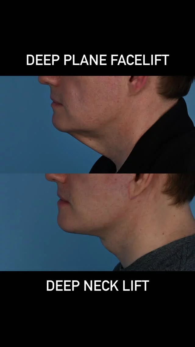 Weight loss can can result in changes to the face and neck.  Often the tissue in the neck becomes loose.  This handsome patient of mine is in his early 50s.  He underwent a significant weight loss.  Unfortunately, his lower face and neck tissue became loose with his weight change.  He underwent #deepplanefacelift and #deepnecklift surgery to address this concern.  He is photographed approximately 3 months following this procedure.  Together, the weight loss and surgery has changed his life.  We are proud that he has chosen us to be involved in his journey. #plasticsurgery #toronto #necklift #torontolife #blooryorkville