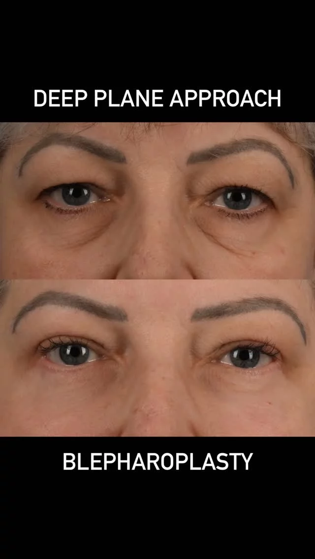 When we see patients who have a significant degree of tissue laxity in the eyelids, it is best to address all the tissue layers including the deeper fat, muscle and skin to attain the best outcome.  This patient of mine is in her mid 50s, and is photographed approximately 5 months following surgery.  She underwent an open sky upper blepharoplasty with fat repositioning, lower eyelid deep plane blepharoplasty with fat transposition, micro fat grafting, orbicularis oculi muscle tightening, conservative skin excision and fractionated erbium laser resurfacing.  The procedure has changed her life in a positive way.  I am grateful she has trusted our practice with her care.  #plasticsurgery #blepharoplasty #oculoplastics #deepplanefacelift #sciton #profactionalskinresurfacing #microfatgrafting #toronto  #torontolife #blooryorkville