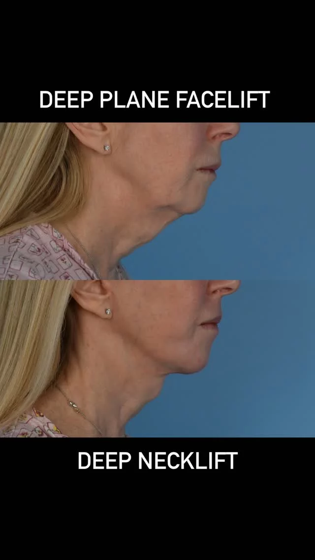 The goal of face and neck lift surgery is always safety followed by not changing the identity of our patients.  This is a self care procedure that is designed to clean up the lower face and neck.  The procedure is one that is worth the investment of the resources and time that our patients commit.  #plasticsurgery #deepplanefacelift #deepnecklift #sciton #morpheus8 #microfatgrafting #toronto  #torontolife #blooryorkville