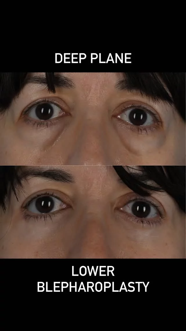 Lower eyelid dark circles are a reflection of a ligament spanning from the bone to the skin named the orbicularis retaining ligament.  The groove closest to the nose is known as the tear trough.  This is formed by a fusion of the orbicularis oculi muscle to the bone.  As we age, the soft tissues surrounding the eye loose their elasticity. Since there is a tethering to bone by these attachments, the dark circles deepen with time.  The most effective was to soften these dark circles is to release these attachments with surgery and interpose fat into this area once the attachments have been removed.  This beautiful patient of mine demonstrates how effective this procedure can be.  The procedure has improved her confidence and the only regret she has is not undergoing this procedure earlier.  #plasticsurgery #blepharoplasty #eyelidbags #fatgraft #oculoplastics #lowerblepharoplasty #toronto  #torontolife #blooryorkville