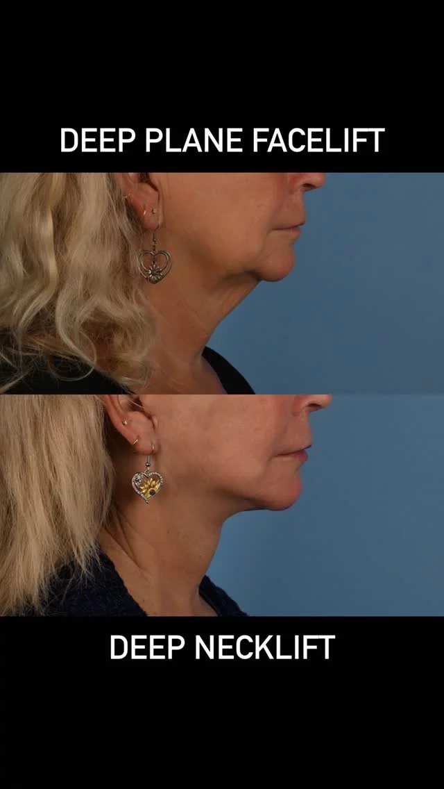 Our neck and jawline lose their crisp shape with time due to several anatomical structures that change with time.  In the face and neck, our platysma muscle relaxes and the submandibular salivary glands often descend with time and become larger.  The diagastric muscles occasionally become larger and the deep neck fat falls and often increases in volume.  The overlying sling loses its elasticity and the fat in the face decreases in volume.  All these structures are often addressed in face and neck lift surgery in order to attain a harmonious and natural outcome.  This beautiful patient of mine is in her early 60s. By addressing multiple deep structures in the face and neck we were able to restore a cleaner shape to her face and neck.  #plasticsurgery #deepplanefacelift #deepnecklift #microfatgrafting #sciton #toronto  #torontolife #blooryorkville