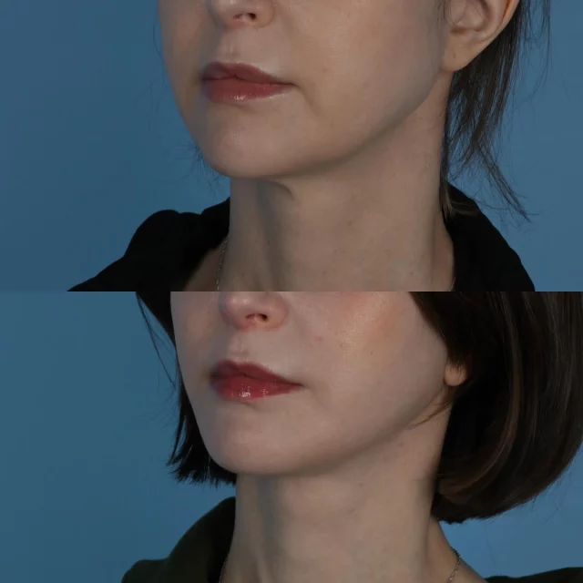 It is common to begin noticing aging changes in the lower face and neck in the mid 40s.  This can manifest as early jowls, facial volume loss, neck skin and platysma laxity as well as a descent of the submandibular glands and thickening of the anterior diagastic muscles.  Being in her late 40s, this beautiful patient of mine wanted to restore her natural crisp features.  She underwent deep plane facelift and deep neck surgery. Although subtle, her results are natural and have made an impact on improving the youthful facial harmony that had previously begun to deteriorate.  I am grateful for her trust in choosing our team to be involved in her care.  #plasticsurgery #deepplanefacelift #deepnecklift #toronto  #torontolife #blooryorkville