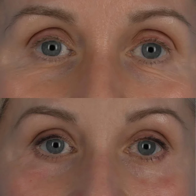Not all people age in the periorbital area by developing droopy upper eyelids and lower eyelid puffiness.  Occasionally, these areas loose volume and the surrounding skin and orbicularis oculi muscle elasticity deteriorates.  This beautiful patient of mine is in her mid 60s.  A deep plane approach to the lower eyelids was performed by tightening the orbicularis oculi muscle and removing the excess lower eyelid skin using a subcilliary incision.  Micro fat grafting was performed to restore the fullness in the upper eyelids and to blend the lower eyelid into the cheek.  A fractionated erbium laser was used to improve the skin quality.  There has been no change to the eyelid shape following surgery.  She is left with a cleaner and younger appearance.  There is no visible scar even at 3 months post procedure.  I am humbled that this patient traveled a great distance to undergo surgery by our practice.  We much appreciate her trust.  #plasticsurgery #blepharoplasty #microfatgrafting #sciton #microfatgrafting #oculoplastics #toronto  #deepplaneblepharoplasty #torontolife #blooryorkville