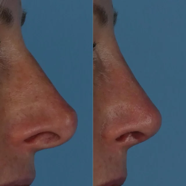 Revision Rhinoplasty involves a restructuring of the underlying cartilage and bony framework of the nose.  The skin then shrink wraps around the new framework.  This beautiful patient of mine is in her late 40s and is photographed approximately 5 weeks following revision rhinoplasty surgery.  She disliked the excessive project of her nose and experienced a collapse of her nostrils when taking a deep breath.  An open approach was used with MTF rib cartilage to stabilize her underlying nasal structure.  The nasal tip was deprojected and the dorsum reduced.  Since surgery, her confidence as improved as has her ability to breathe through her nose.  I am grateful that she has trusted me with her care.  #plasticsurgery #rhinoplasty #revisionrhinoplasty #mtfbiologics #toronto  #torontolife #blooryorkville
