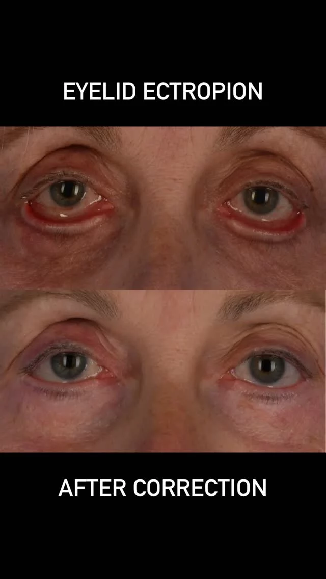 Patients commonly ask if I perform lower eyelid blepharoplasty surgery using an internal (transconjunctival) or external (transcutaneous) incision.  My reply is both.  If a patient is younger and has lower eyelid puffiness and good tissue quality/elasticity, an  internal incision is often best.  However, if the orbicularis oculi muscle has lost its elasticity and bunches up when the patient smiles, it is important to tighten the lower eyelid orbicularis oculi muscle.  This approach is performed through an external incision. Not only does it effectively correct the excess loose muscle and skin but it also supports the lower eyelid and avoids a change in lower eyelid shape following surgery.  This extremely kind patient of mine, who is in her early 70s, underwent previous lower blepharoplasty surgery.  The original procedure did not include a tightening of the lower eyelid orbicularis oculi muscle.  Unfortunately, she developed a retraction of the lower eyelid following surgery and lower eyelid ectropion.  I was able to perform lower eyelid revision surgery, which included a canthoplasty and lower orbicularis oculi tightening to restore her eyelid shape and function.  This experience has reminded me how helpful our profession can be in improving the quality of life of our patients.  I am grateful that my patient trusted me with her revision surgery.  #plasticsurgery #blepharoplasty #oculoplastics #torontolife #blooryorkville