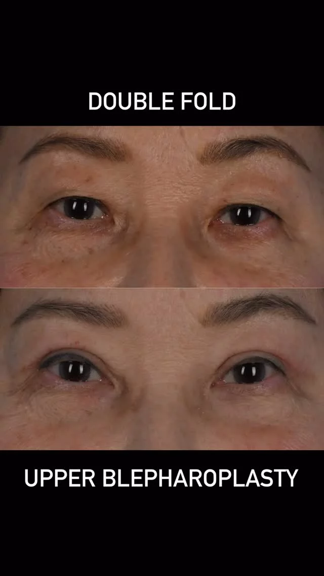 Double fold blepharoplasty surgery is much different then upper blepharoplasty surgery.  The double fold procedure is typically performed in patients of Asian descent and involves constructing a fold where one did not exist.  The most durable and reliable technique involves and incision being placed where the new crease is desired.  Furthermore, the levator aponeurosis is anchored using deep sutures to the tarsal plate and overlying orbicularis oculi muscle.  Upper eyelid fat is redistributed and a conservative amount of skin is removed.  #torontolife #blooryorkville #doublefoldblepharoplasty #oculoplastics #blepharoplasty