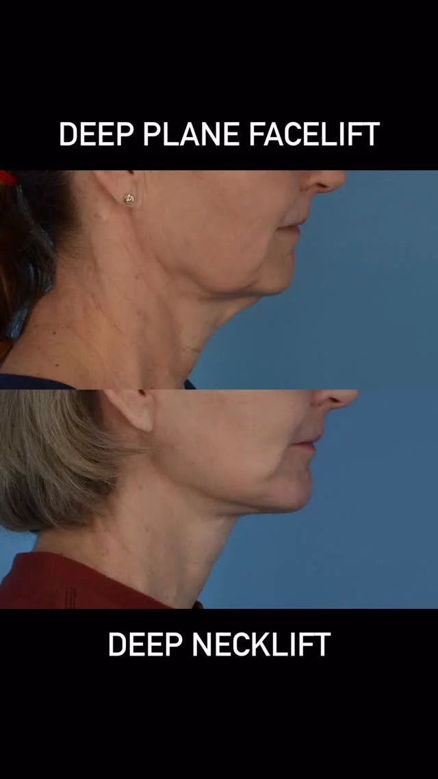 For over twenty years, the mission statement for patient care in our practice has remained the same.  1. Safety  2. Maintenance of Patient Identity  3. The Treatment Needs to Result in a Noticeable Outcome.  The “Art” of Plastic Surgery is to produce a result that looks natural and cleaner.  The best compliment that our patients often receive is that no one has commented that they have had surgery.  This is especially true with facial rejuvenation surgery.  This beautiful patient of mine is photographed 3 months following deep plane facelift, deep necklift, micro fat grafting and full face Erbium laser treatment (both TRL and fractionated). I am grateful that she has trusted me with her care.  #deepplanefacelift #torontolife #blooryorkville #sciton #microfatgrafting