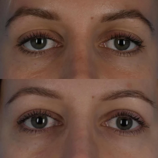 It is always important to assess our patients for upper eyelid ptosis when considering upper eyelid blepharoplasty surgery.  Eyelid ptosis is a droopy appearance to the upper eyelid which is often due to a laxity of a ligament that allows the upper eyelid to open fully.  If this ligament is not tightened during upper eyelid blepharoplasty, this may result in the upper eyelid appearing more droopy following surgery.  This beautiful patient of mine is photographed approximately 6 weeks following upper blepharoplasty and tarsolevator advancement (ptosis repair) surgery.  Her eyes are now wide open and have a crisp and more alert appearance. Her upper eyelids also appear fuller, as the fat in the upper eyelids was redistributed and preserved using an open sky approach.  I am grateful that she has trusted me with her care.  #blepharoplasty #ptosiscorrection #oculoplastics #torontolife #blooryorkville