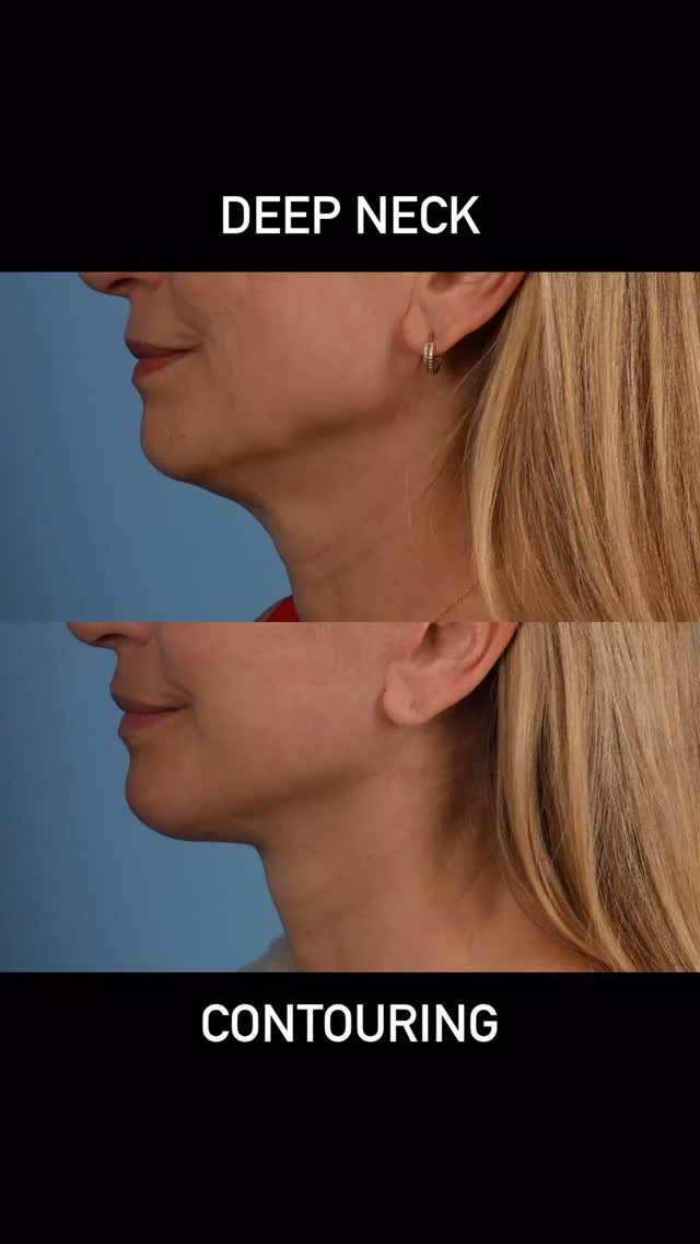 In order to achieve a clean neck contour, it is important to understand why our necks lose their crop appearance as we age.  Wii age, our necks lose their skin and platysma muscle loses its elasticity.  As this occurs, the deeper neck structures that the platysma supports tend to sag downwards.  The submandibular salivary glands also become larger and often produce a visible bump in the neck.  The deep neck fat sags and occasionally the deep diagastic muscles become bulky.  To attain an optimal outcome, it is vital to consider removing some of the enlarged submandibular salivary glands and anterior diagastic muscles, to contour the deep neck fat and to tighten the overlying platysma muscle with an anterior platysmaplasty and facelift procedures.  #plasticsurgery #torontolife #blooryorkville #deepplanefacelift #necklift