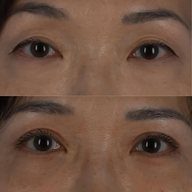 Double fold upper blepharoplasty is a very effective way to clean up either an irregular upper eyelid crease or to change an upper eyelid that does not have a crease.  By doing so, there is less weight placed on the upper eyelashes which in turn causes the forehead to strain less.  Makeup becomes easier to apply and the eyes tend to look more well rested and alert.  This beautiful patient of mine who is in her early 50s is photographed approximately 3 months following surgery.  She underwent upper and lower blepharoplasty surgery, with the creation of an upper eyelid double fold.  She is thrilled with her outcome as am I.  #plasticsurgery #blepharoplasty #oculoplastics #torontolife #blooryorkville