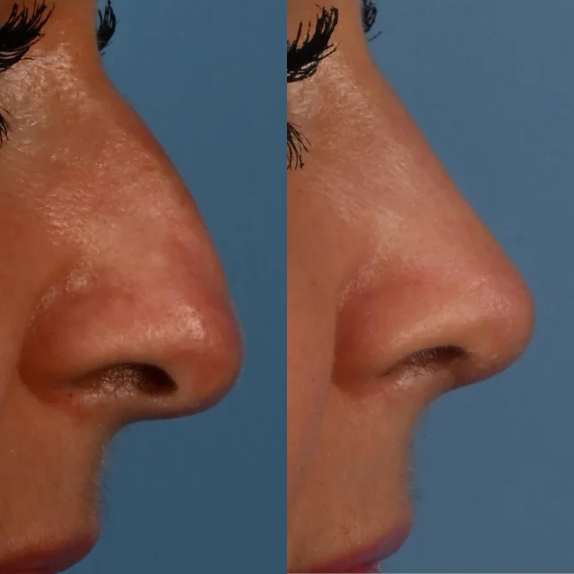 Rhinoplasty is a craft.  Like all crafts, there are many different was to achieve an optimal outcome.  Ultimately, safety and delivering improved facial harmony without changing one’s identity is the goal.  This beautiful patient of mine is photographed approximately 3 months following open structural rhinoplasty.  The following ares were addressed:  dorsal hump, boxy nasal tip and droopy nasal tip.  We are thrilled with her outcome and are grateful for her trust.  #rhinoplasty #toronto  #blooryorkville #torontolife #plasticsurgery