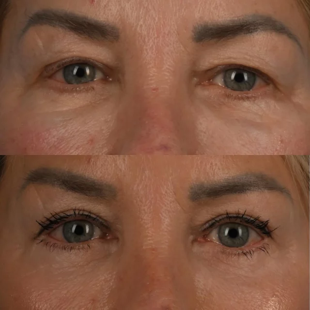 Tear trough filler use is very common.  We now know that HA fill can last in excess of 10 years in the lower eyelid and upper cheek region.  It can often migrate and expand to present as a new fullness in the lower eyelid.  It is important to identify a history of prior filler use and to dissolve the filler using a hyaluronadase injection prior to surgery.  HA filler in the upper cheeks can present with prolonged swelling following blepharoplasty surgery.  This beautiful patient of mine who is in her early 60s is photographed approximately 10 months following surgery.  She underwent deep plane upper and lower blepharoplasty surgery with micro fat grafting to the upper cheek region.  A fractionated #sciton erbium laser was used to improve the skin quality of the eyelids.  Prior to surgery, her previous HA filler was dissolved in the office setting.  This can be seen as a fullness in the tear trough region in the preoperative photograph.  She is thrilled with her new cleaner appearance.  I am grateful for her trust.  #oculplastics #blepharoplasty #torontolife #blooryorkville