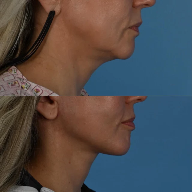 When can I be presentable following deep plane face lift and deep neck surgery.  Most patients are back to work and comfortable in public at 3 weeks.  This beautiful patient of mine is photographed approximately 6 weeks post surgery including submandibular salivary gland contouring.  She is back to normal life and feels more confident with her new cleaner appearance.  I am grateful for her trust in choosing me as her surgeon.  #plasticsurgery #deepplanefacelift #torontolife #blooryorkville #necklift
