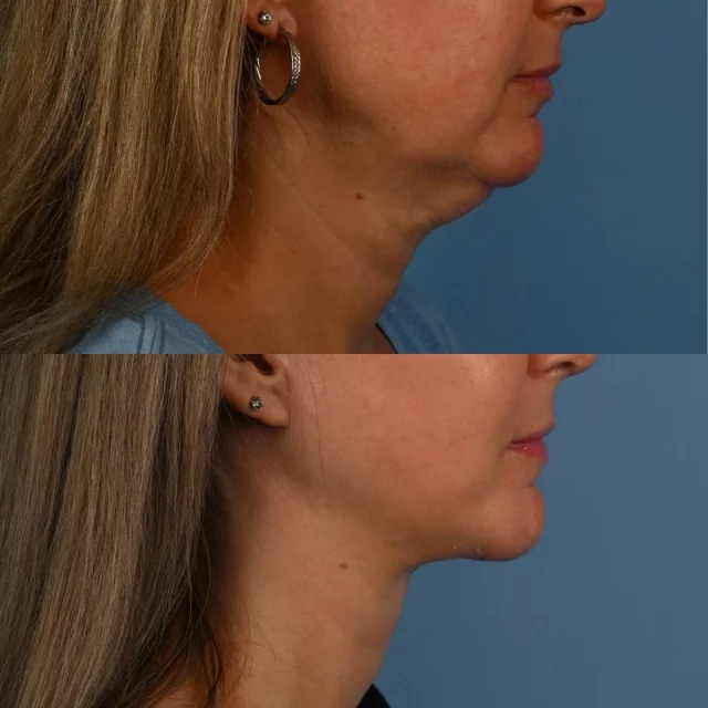As we age, the platysma muscle becomes more lax in both the lower face and neck.  It is often important to address both the neck and the face together to attain the best facial harmony. This includes achieving a uniform shadow under the body of the mandible or jaw.  This very kind patient of mine is in her late 40s, and is photographed approximately 3 months following deep plane face and neck lift surgery.  It is always rewarding to compare before and after photographs to witness how this procedure cleans up the lower face and neck.  #deepplanefacelift #torontolife #blooryorkville #necklift #facelift