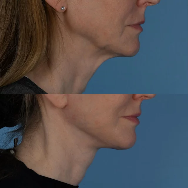 In order to achieve optimal face and neck lift results, it is important to release deep retaining ligaments of the face and neck.  This allows for a repositioning of tissue rather than pulling.  The result is a more durable and natural outcome with excellent scars as there is no tension placed on the skin.  This kind and beautiful patient of mine is in her mid 50s.  She is photographed 3 months following deep plane face lift and deep neck surgery with submandibular gland contouring.  She could not stop smiling during her most recent post operative office visit.  Seeing our patients this happy is one of the best feelings we experience as surgeons.  I am grateful she has trusted me with her care.  #deepplanefacelift #submandibulargland #microfatgrafting #torontolife #blooryorkville