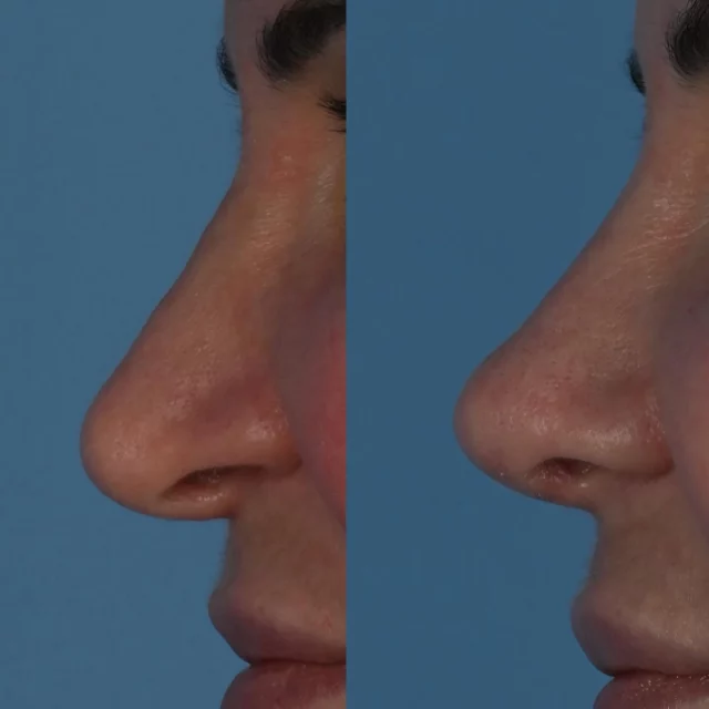 Revision rhinoplasty surgery often requires the use of a cartilage graft.  This is often taken from a rib but can also be attained from a human donor (MTF Biologics). This very kind patient of mine is photographed approximately 3 months following revision rhinoplasty surgery.  An MTF graft to stabilize the nose and to ensure the nasal airway functions optimally.  The droopy tip was deprojected, rotated and stabilized.  The width of the nasal ala were reduced.  Lastly, a septoplasty was performed and the internal nasal valve was splinted open using  extended speeder grafts.  The original rhinoplasty was performed in a closed manner many years prior to this revision.  I am grateful that she has trusted me with her care.  #mtfbiologics #rhinoplasty #revisionrhinoplasty #torontolife #blooryorkville